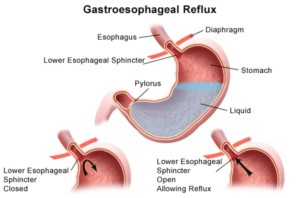 Reflusso gastroesofageo cause sintomi dieta 1 dietaokit